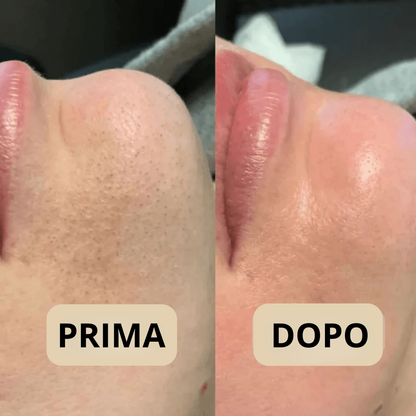 Peel Shot Coreano, elimina le impurità e valorizza la tua pelle