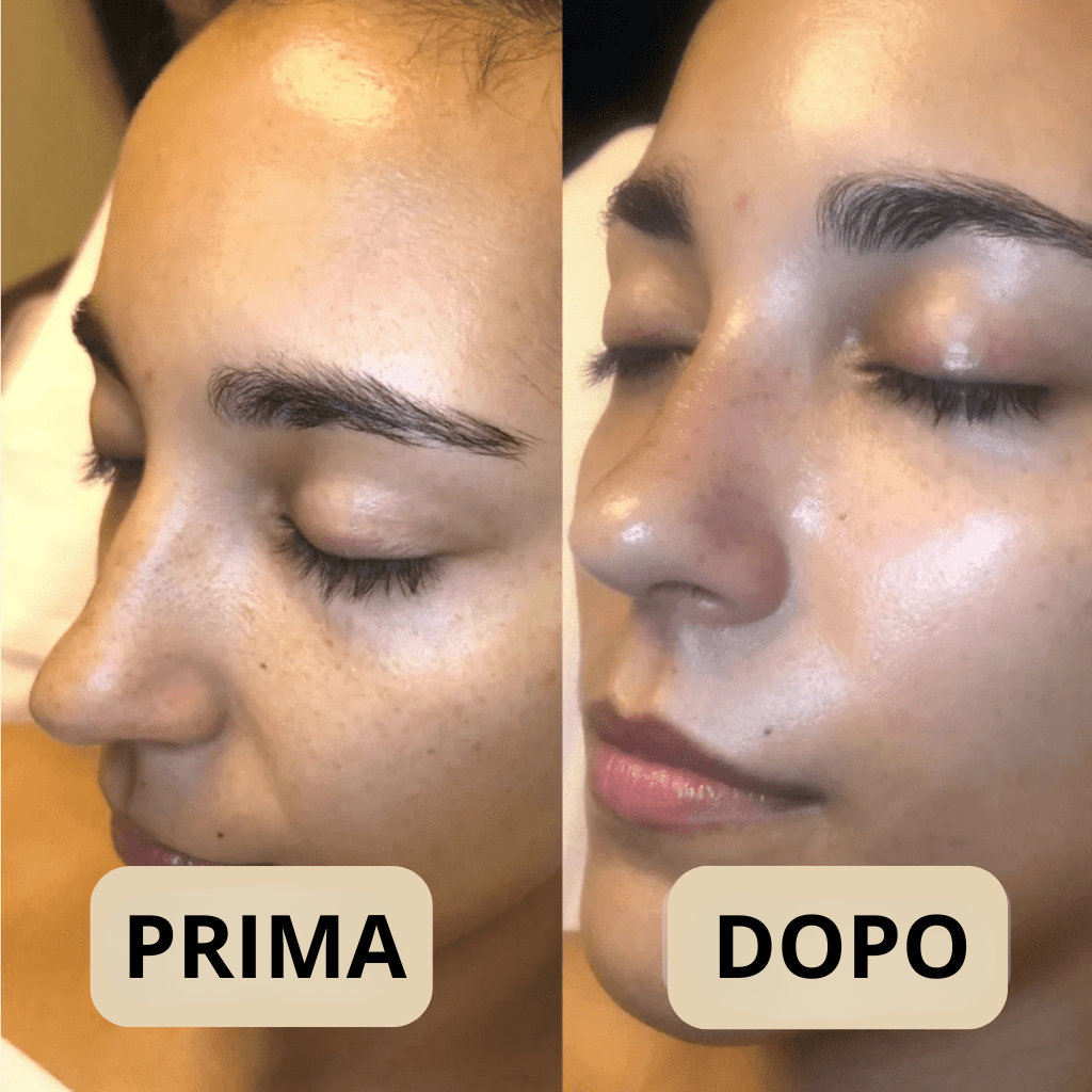 Peel Shot Coreano, elimina le impurità e valorizza la tua pelle